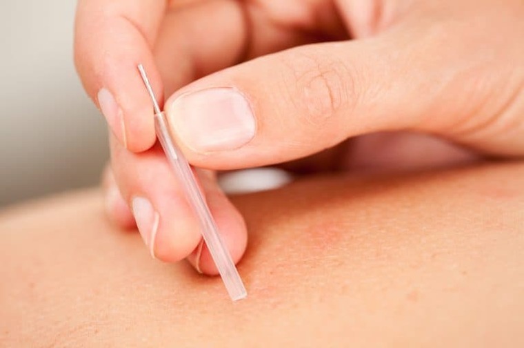 Using Dry needling for pain and why is different from acupuncture