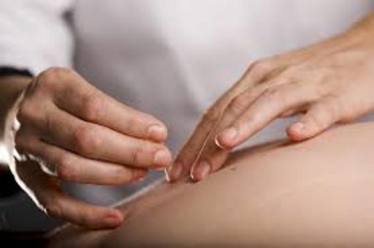 Acupuncture as alternative treatment for infertility